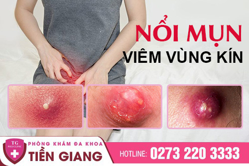 Âm Đạo Nổi Mụn Có Nguy Hiểm Không? Nguyên Nhân & Cách Điều Trị
