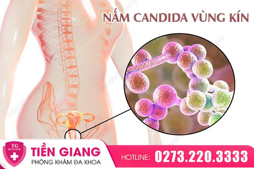 Nấm Candida Vùng Kín Là Bệnh Gì? Nhận Biết Sớm Để Tránh Tái Phát