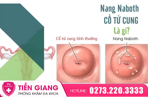 Nang Naboth là các u nang nhỏ hình thành trên bề mặt cổ tử cung.