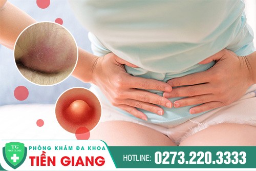 Sưng vùng kín