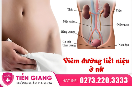 Viêm đường tiết niệu là căn bệnh xảy ra phổ biến ở nữ hiện nay.