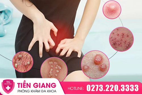 Nổi Cục U Ở Mép Vùng Kín Có Nguy Hiểm Không? Cách Xử Lý Hiệu Quả